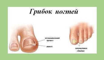 Онихомикоз (грибок ногтей)